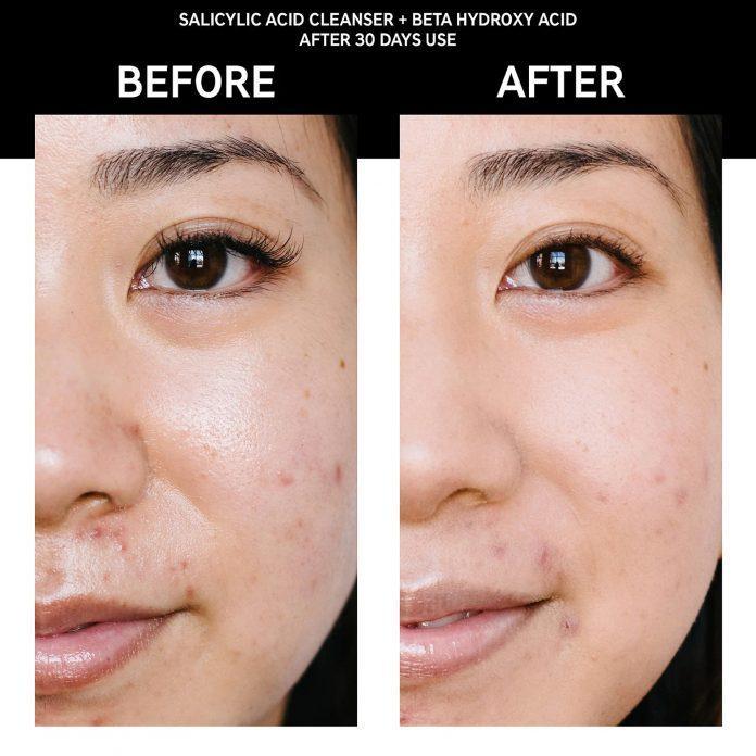 Sữa rửa mặt trị mụn The Inkey List Salicylic Acid Cleanser